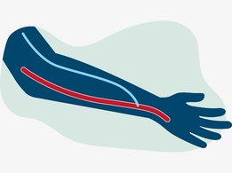 A-V zkrat: Arteriovenózní zkrat