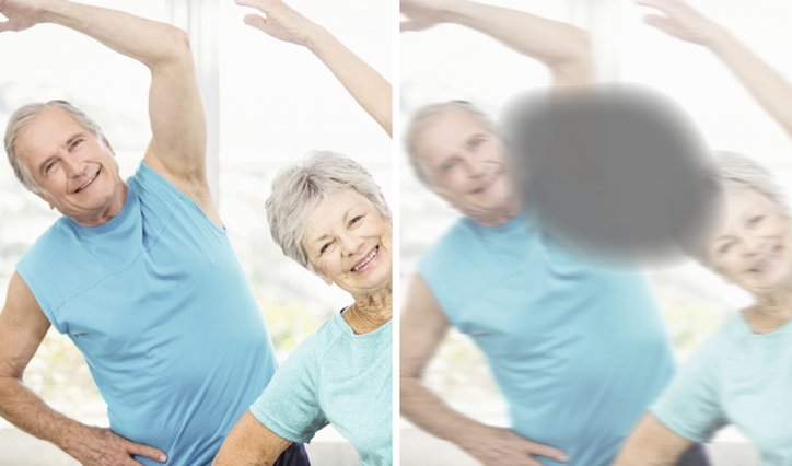 age-related macular degeneration