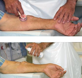 _pt_vascular_access-2_